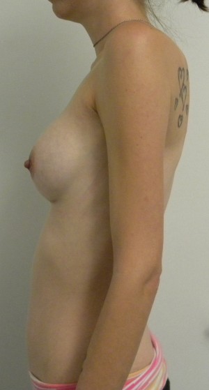 Breast Augmentation