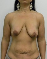 Breast Augmentation