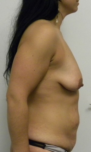 Breast Augmentation Case 8417 Before Photo Breast Augmentation