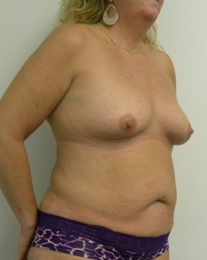 Breast Augmentation