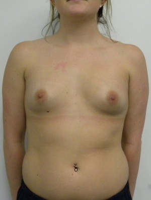 Breast Augmentation