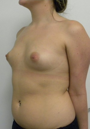 Breast Augmentation