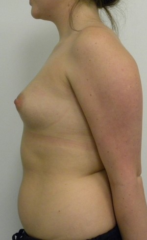 Breast Augmentation