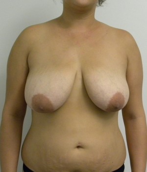 Breast Lift Case 8370 Before Photo Breast Lift