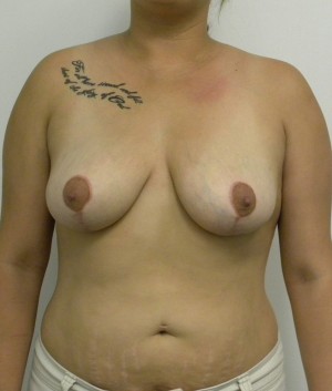 Breast Lift Case 8370 After Photo Breast Lift