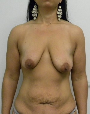 Breast Lift Case 8389 Before Photo Breast Lift