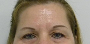 Brow Lift/Forehead Rejuvenation Case 8349 Before Photo Brow Lift/Forehead Rejuvenation
