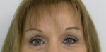 Brow Lift/Forehead Rejuvenation