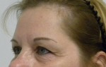 Brow Lift/Forehead Rejuvenation