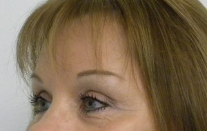 Brow Lift/Forehead Rejuvenation Case 8349 After Photo Brow Lift/Forehead Rejuvenation