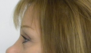 Brow Lift/Forehead Rejuvenation Case 8349 After Photo Brow Lift/Forehead Rejuvenation