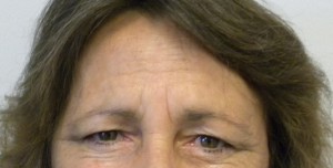 Brow Lift/Forehead Rejuvenation Case 8356 Before Photo Brow Lift/Forehead Rejuvenation