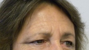 Brow Lift/Forehead Rejuvenation Case 8356 Before Photo Brow Lift/Forehead Rejuvenation