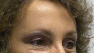 Brow Lift/Forehead Rejuvenation Case 8356 After Photo Brow Lift/Forehead Rejuvenation