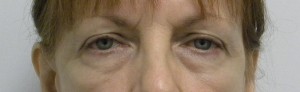 Eyelid Surgery