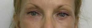 Eyelid Surgery Case 8339 After Photo Eyelid Surgery