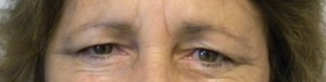Eyelid Surgery Case 8342 Before Photo Eyelid Surgery