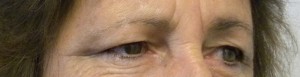 Eyelid Surgery Case 8342 Before Photo Eyelid Surgery