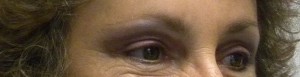 Eyelid Surgery Case 8342 After Photo Eyelid Surgery