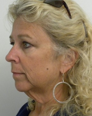 Facelift Case 8320 Before Photo Facelift