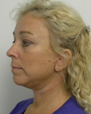 Facelift Case 8320 After Photo Facelift