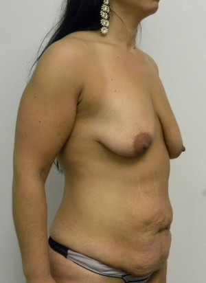 Mommy Makeover Case 8296 Before Photo Mommy Makeover