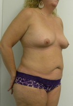Mommy Makeover