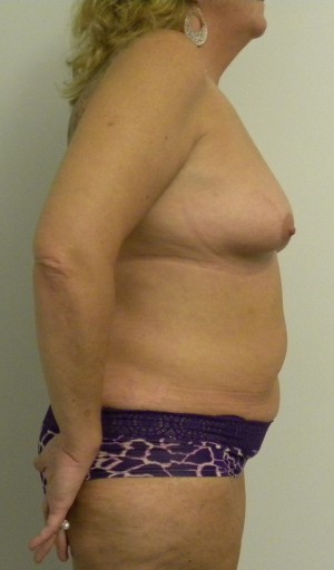 Mommy Makeover Case 8303 Before Photo Mommy Makeover