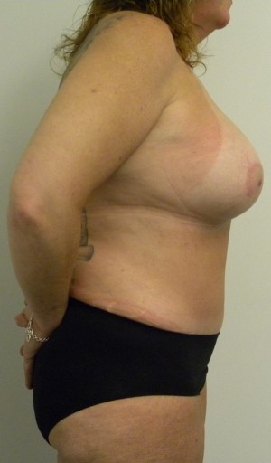 Mommy Makeover Case 8303 After Photo Mommy Makeover