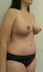 Mommy Makeover