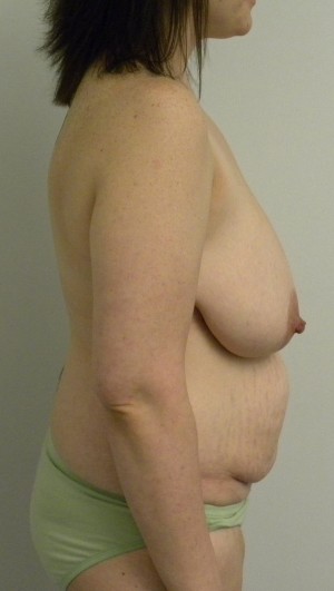 Mommy Makeover Case 8310 Before Photo Mommy Makeover