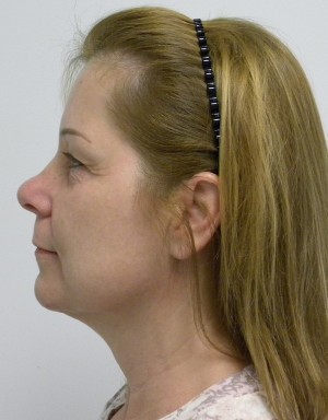 Neck Lift Case 8293 Before Photo Neck Lift