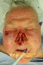 Skin Cancer Reconstruction