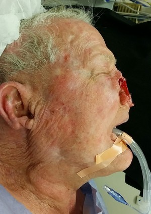 Skin Cancer Reconstruction Case 8282 Before Photo Skin Cancer Reconstruction