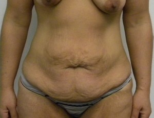 Tummy tuck (Abdominoplasty)