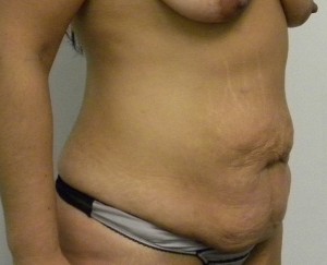 Tummy tuck (Abdominoplasty)