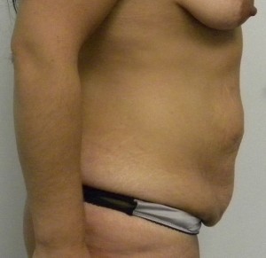 Tummy tuck (Abdominoplasty) Case 8261 Before Photo Tummy tuck (Abdominoplasty)