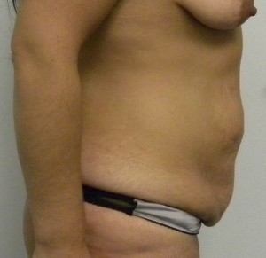 Tummy tuck (Abdominoplasty)