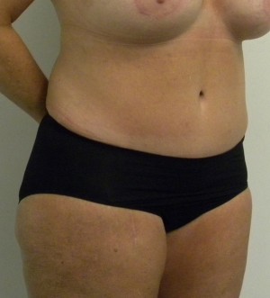 Tummy tuck (Abdominoplasty)