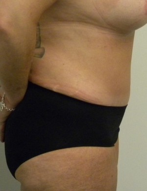 Tummy tuck (Abdominoplasty)