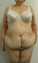 Tummy tuck (Abdominoplasty)