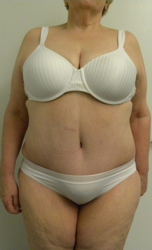 Tummy tuck (Abdominoplasty) Case 8275 After Photo Tummy tuck (Abdominoplasty)