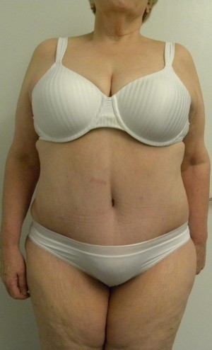 Tummy tuck (Abdominoplasty)