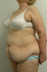 Tummy tuck (Abdominoplasty)