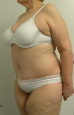 Tummy tuck (Abdominoplasty)