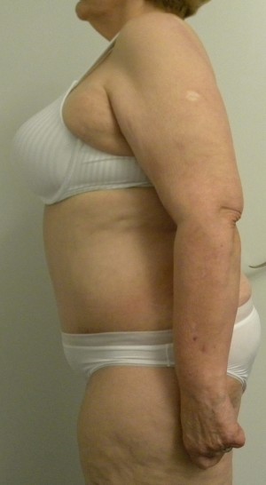 Tummy tuck (Abdominoplasty)