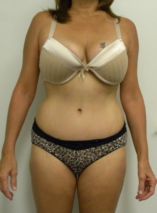Tummy tuck (Abdominoplasty) Case 8254 After Photo Tummy tuck (Abdominoplasty)
