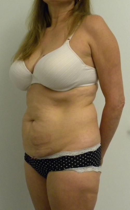 Tummy tuck (Abdominoplasty)