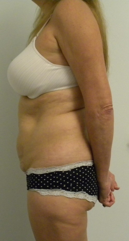 Tummy tuck (Abdominoplasty) Case 8254 Before Photo Tummy tuck (Abdominoplasty)