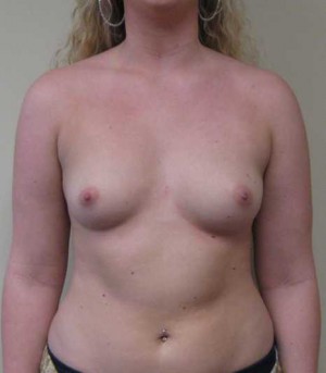 Breast Augmentation Case 8247 Before Photo Breast Augmentation